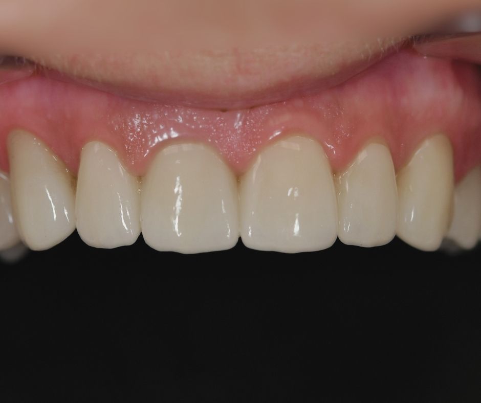 cirkon keramicke krunice